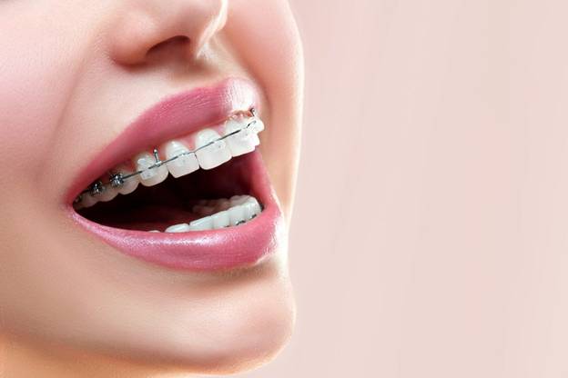 Ceramic vs Metal Braces